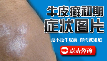 西安那家医院治疗银屑病比较好