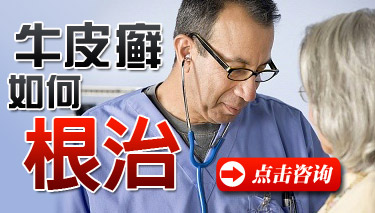 西安治疗牛皮癣可以治愈吗