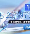 烟台治疗牛皮癣那个医院最好