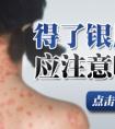 烟台什么医院治牛皮癣好